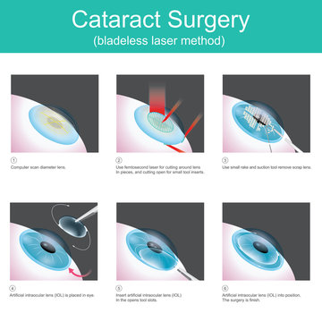 Cataract Surgery. The use of medical lasers to cutting eye lens in small pieces and suction out, in order to use artificial lenses, because the symptoms are cataracts.
