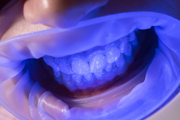 UV Whitening teeth. Administer anesthetics to keep patients from feeling pain during procedures....