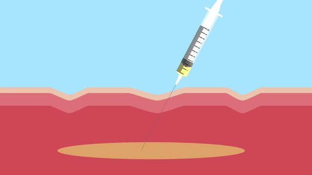skin filler graphic animation . It can cure the wrinkle