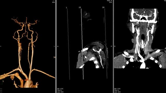  computed tomography angiography ( CTA ) of the neck 3D rendering image , sagittal and coronal plane image.