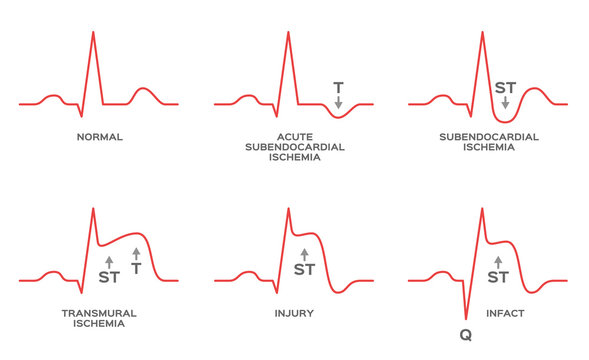 Diagnosis Myocardial Ischemia Vector / NSTEMI, STEMI