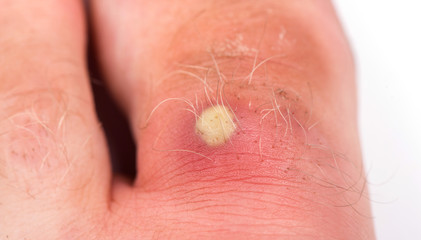 purulent pimple on toe