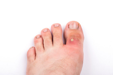 purulent pimple on toe