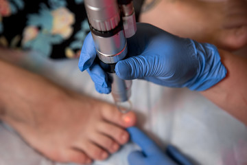 Podology treatment. Podiatrist treating toenail fungus. Doctor removes calluses, corns and treats ingrown nail. Hardware manicure. Health, body care concept. Selective focus. - obrazy, fototapety, plakaty