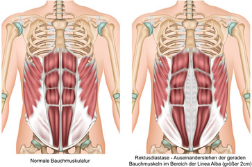 Rektusdiastase Anatomie Bauchmuskeln vektor illustration - obrazy, fototapety, plakaty