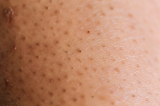 Closeup of caucasian skin with ingrown hair
