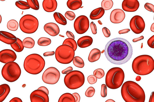 Hemotransfusion in treatment of anemia, 3D illustration showing two populations of red blood cells, small hypochromic red blood cells and normal. A small lymphocyte is drawn for size comparison