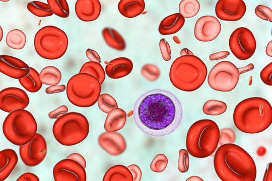 Hemotransfusion in treatment of anemia, 3D illustration showing two populations of red blood cells, small hypochromic red blood cells and normal. A small lymphocyte is drawn for size comparison
