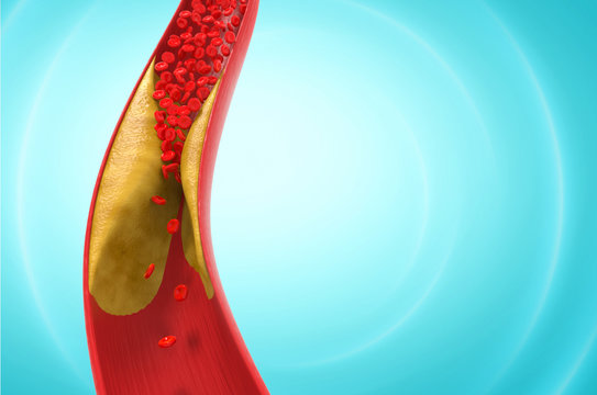 blood cells with plaque buildup of cholesterol 3d Illustration.