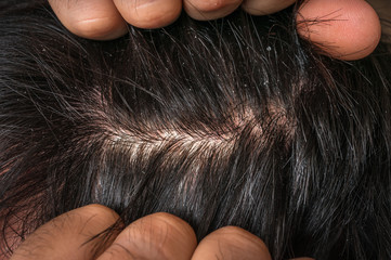 Closeup view of hair of a man with dandruff