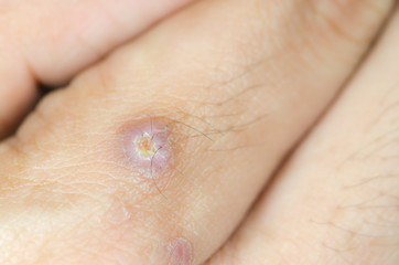 Abscess on man hand,select focus