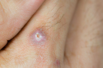 Abscess on man hand,select focus