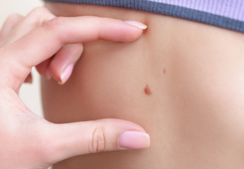 Doctor's hands checking moles on patient skin.