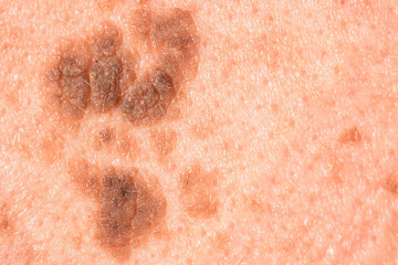 Moles on skin. Nevus should examine because of the risk ofmelanoma skin cancer.