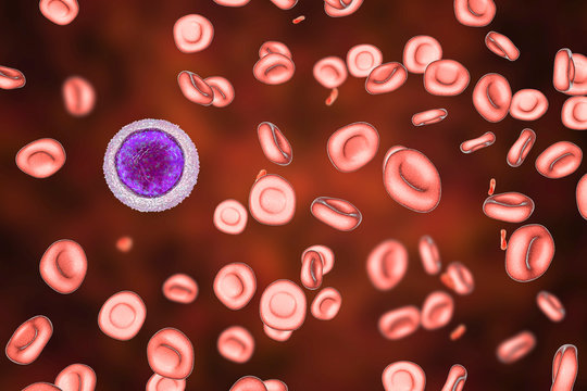 Iron deficiency anemia, 3D illustration showing small hypochromic red blood cells, anisocytosis. A small lymphocyte is drawn for size comparison
