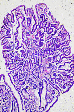 Intestinal adenomatosis