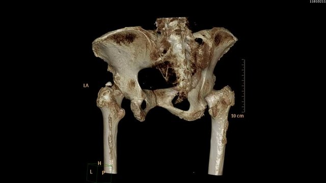 CT SCAN image of pelvic bone / Hip bone 3D rendering image Rotating on monitor .