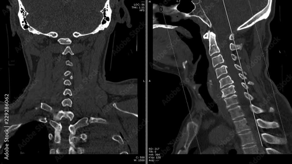 Poster ct scan of cervical spine ( c-spine ) patient trauma case , coronal and sagittal view with 3d render