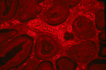 Intestinal adenomatosis