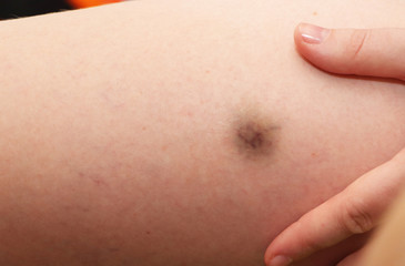 A bright injury injures the thigh of a young woman. The concept of pain close-up. Hematoma on the leg.