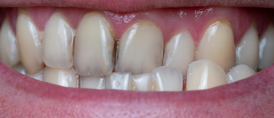 Closeup of dental plaque on man's teeth caused by coffee residual