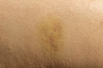 bruises on women's skin close up