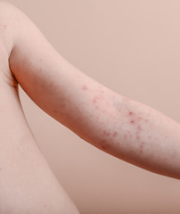 boy with a skin rash, chickenpox, coxsackie.