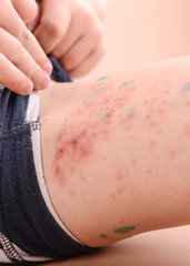boy with a skin rash, chickenpox, coxsackie.