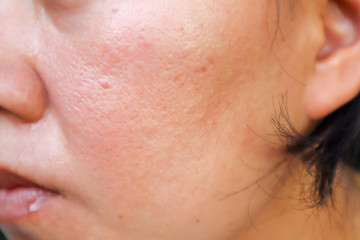 Scar from Acne on face.