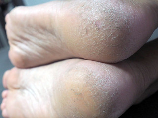 Fototapeta premium Heel break close up.