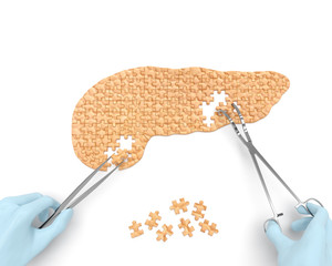 Pancreas puzzle concept: hands of surgeon with surgical instruments (tools) perform pancreas...