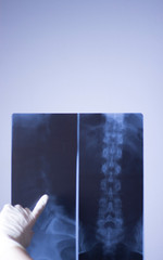 Medical xray spine hip scan