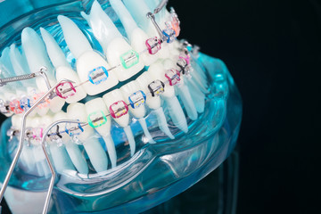 orthodontic model and dentist tool - demonstration teeth model of varities of orthodontic bracket or brace
