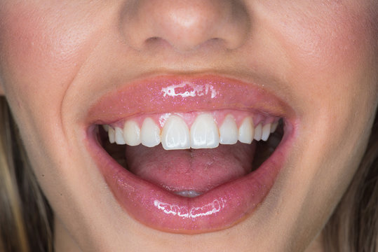 Smile broadly. Dental care. Sexy lips of sexi woman. Sexy woman with white smile. Silicone injection for lips. Silicone dental braces. Botox treatment. Botox and filler. Makeup is so transformative