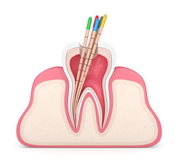 3d render of tooth in gums with gutta percha