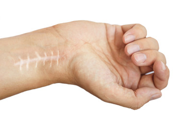 Scar with stitches on the wrist after surgery. Fracture of the bones of the hands in fist isolated...