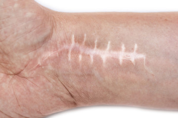 Fototapeta premium Scar with stitches on the wrist after surgery. Fracture of the bones of the hands in fist isolated on white background