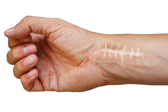 Scar with stitches on the wrist after surgery. Fracture of the bones of the hands in fist isolated on white background