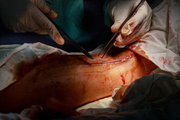 Surgeons working on a patient foot in a operating theater