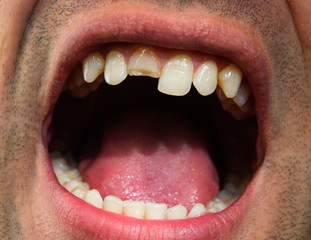 Broken tooth. Broken upper incisor in a man mouth. Man shows oral cavity to the dentist. Treatment...