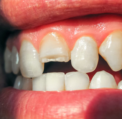 Broken tooth. Broken upper incisor in a man mouth. Man shows oral cavity to the dentist. Treatment...