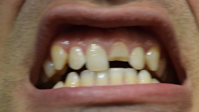 Broken tooth. Broken upper incisor in a man mouth. Man shows oral cavity to the dentist. Treatment of a broken tooth.