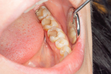 Obraz premium Dental caries. Filling with dental composite photopolymer material using rabbders. The concept of dental treatment in a dental clinic