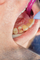 Obraz premium Dental caries. Filling with dental composite photopolymer material using rabbders. The concept of dental treatment in a dental clinic