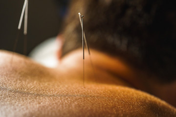 acupuncture needle  - obrazy, fototapety, plakaty