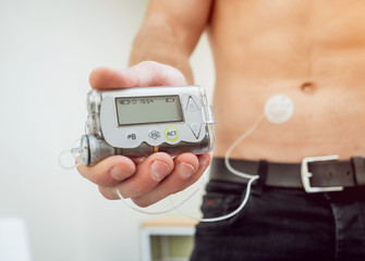 Diabetic man with an insulin pump connected in his abdomen and holding the insulin pump at his hands.