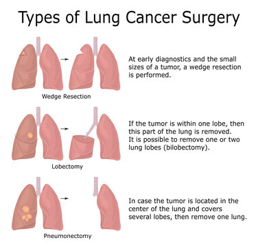 Types of Lung Cancer Surgery