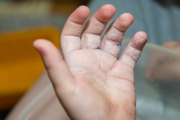 Stitches on child's finger