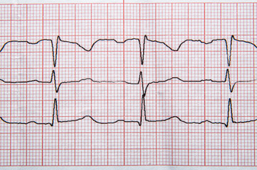 Medical research. Fragment of a normal electrocardiogram with arrhythmia elements.