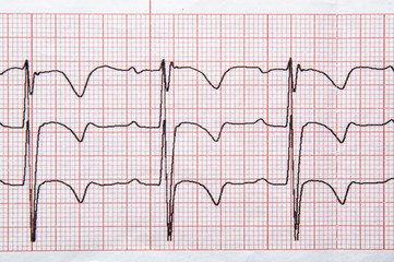 Medical research. Fragment of a normal children's electrocardiogram with arrhythmia elements.